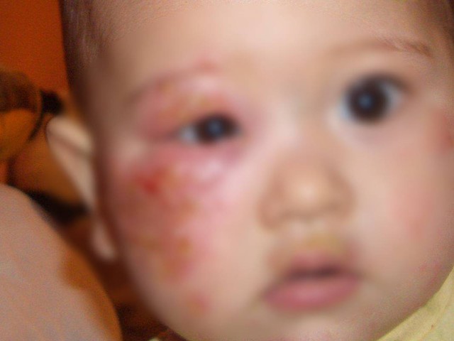 Bé gái 4 tuổi mắc giang mai - nguồn lây không ngờ từ một thói quen chăm cháu của người bà - Ảnh 2.