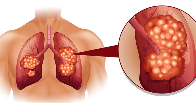 Không phải ngẫu nhiên mà nhiều gia đình liên tiếp có người mắc cùng một ung thư: 6 bệnh ung thư mang dấu ấn di truyền rõ rệt - Ảnh 4.