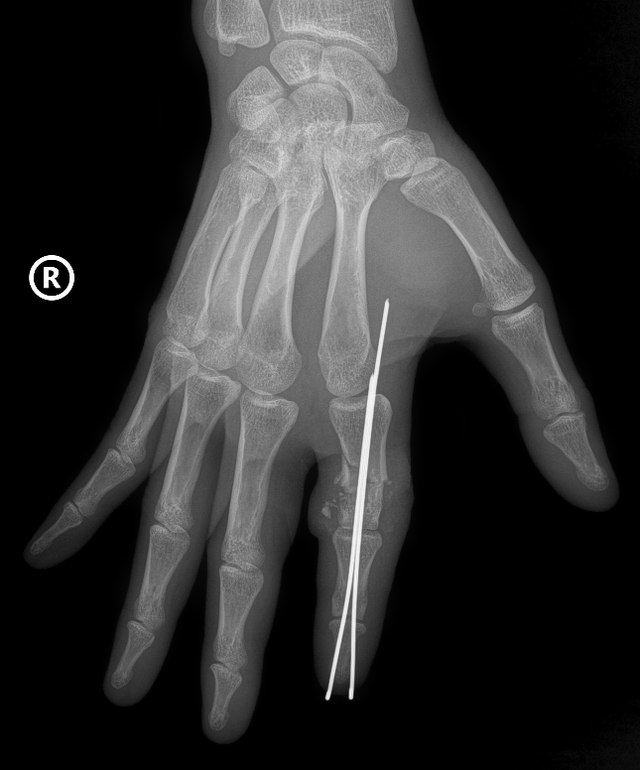 Thủy thủ bị đứt rời ngón tay giữa bão, được nối thành công sau 25 giờ thiếu máu - Ảnh 1.