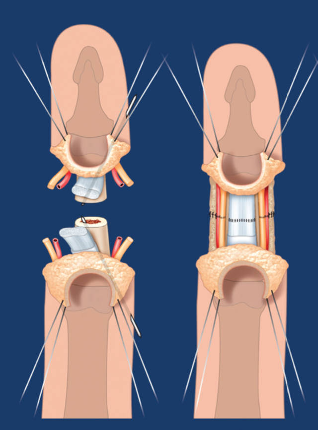 Thủy thủ bị đứt rời ngón tay giữa bão, được nối thành công sau 25 giờ thiếu máu - Ảnh 2.