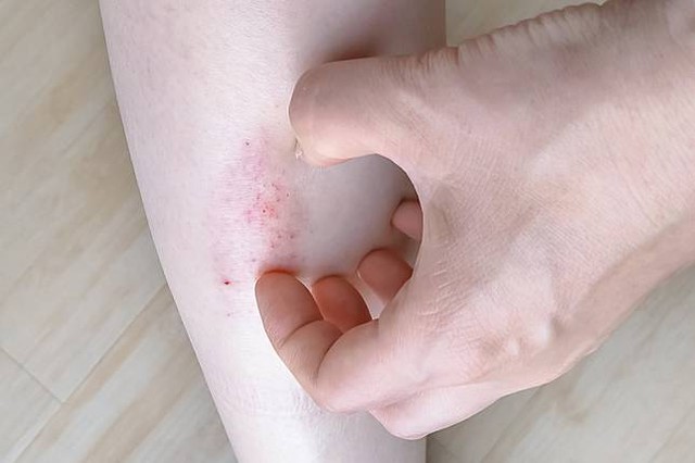 Người đàn ông 40 tuổi phát hiện ung thư gan giai đoạn cuối: Đáng tiếc ông đã bỏ qua dấu hiệu suốt 3 tháng - Ảnh 2.