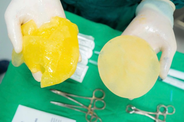 Nhiều chị em 30-40 tuổi vừa nâng ngực, vừa mê Pickleball: Bác sĩ cho chơi hay bảo nghỉ? - Ảnh 2.