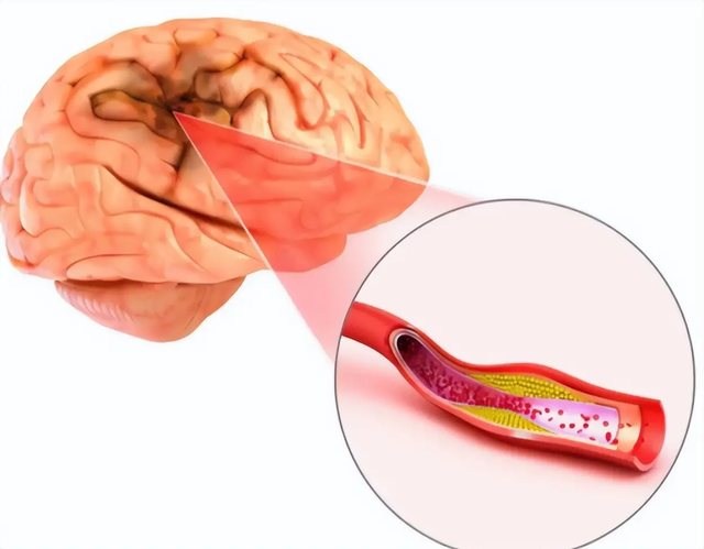 Nếu xuất hiện các triệu chứng này, bạn cần đi khám ngay lập tức vì đây có thể là dấu hiệu cảnh báo đột quỵ - Ảnh 2.