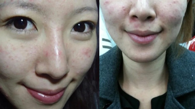 Nữ nghệ sĩ khổ sở v&igrave; bệnh da suốt 7 năm, s&aacute;ng soi gương l&agrave; bật kh&oacute;c: B&aacute;c sĩ cảnh b&aacute;o bệnh trứng c&aacute; đỏ kh&ocirc;ng chỉ li&ecirc;n quan đến da mặt - Ảnh 2.