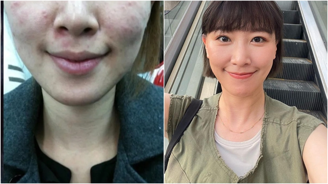 Nữ nghệ sĩ khổ sở v&igrave; bệnh da suốt 7 năm, s&aacute;ng soi gương l&agrave; bật kh&oacute;c: B&aacute;c sĩ cảnh b&aacute;o bệnh trứng c&aacute; đỏ kh&ocirc;ng chỉ li&ecirc;n quan đến da mặt - Ảnh 1.