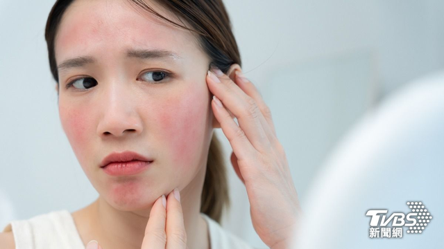Nữ nghệ sĩ khổ sở v&igrave; bệnh da suốt 7 năm, s&aacute;ng soi gương l&agrave; bật kh&oacute;c: B&aacute;c sĩ cảnh b&aacute;o bệnh trứng c&aacute; đỏ kh&ocirc;ng chỉ li&ecirc;n quan đến da mặt - Ảnh 3.