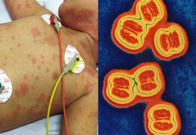 Não mô cầu diễn biến đáng lo ngại: Tiêm vaccine thế nào để phòng bệnh hiệu quả? - Ảnh 1.