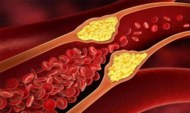 2 Thực phẩm l&agrave;m tăng triglyceride mạnh hơn cả thịt chi&ecirc;n r&aacute;n m&agrave; bạn kh&ocirc;ng ngờ tới - Ảnh 5.