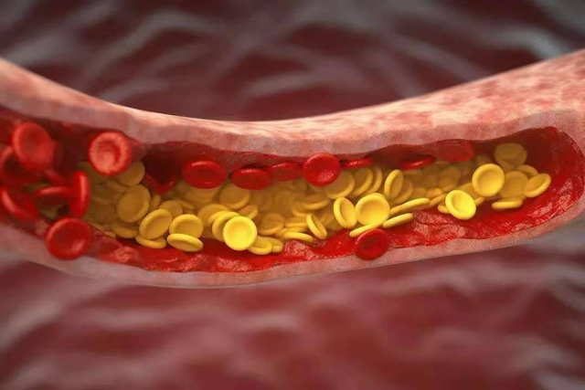 Không phải đi bộ thật nhiều, đây mới là 3 việc quan trọng giúp làm chậm quá trình tắc nghẽn mạch máu - Ảnh 1.