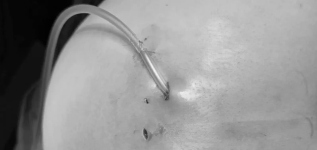Thận trọng khi ti&ecirc;m filler v&agrave;o cơ thể - Ảnh 1.