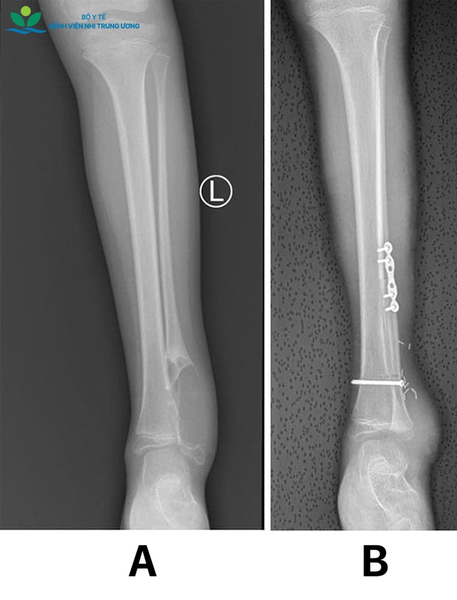 Món quà đặc biệt dịp 27/2: Cứu đôi chân bé gái 8 tuổi khỏi nguy cơ tàn phế vì ung thư sụn - Ảnh 4.