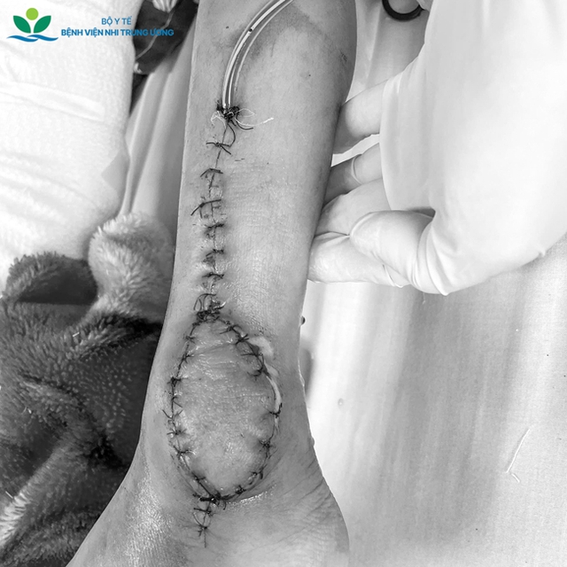 Món quà đặc biệt dịp 27/2: Cứu đôi chân bé gái 8 tuổi khỏi nguy cơ tàn phế vì ung thư sụn - Ảnh 5.