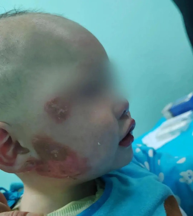 Bé 1 tuổi bị bỏng mặt, gia đình bôi đầy kem đánh răng theo “mẹo dân gian”: Bác sĩ cảnh báo có thể gây nhiễm trùng nặng - Ảnh 2.