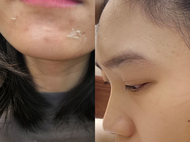 Peel da không phải “cứ làm là đẹp”: Chuyên gia cảnh báo 4 sai lầm khiến da càng ngày càng tệ - Ảnh 4.