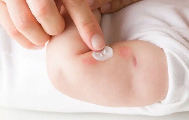 Bé hay bị hăm đỏ vùng mông? Đừng vội đổ lỗi cho tã, 90% bố mẹ đang chăm sai mà không biết - Ảnh 2.