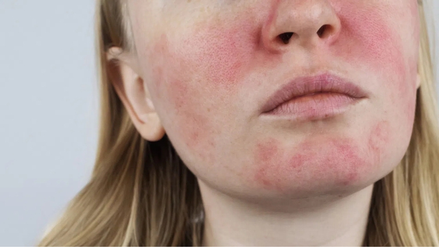 Peel da không phải “cứ làm là đẹp”: Chuyên gia cảnh báo 4 sai lầm khiến da càng ngày càng tệ - Ảnh 2.