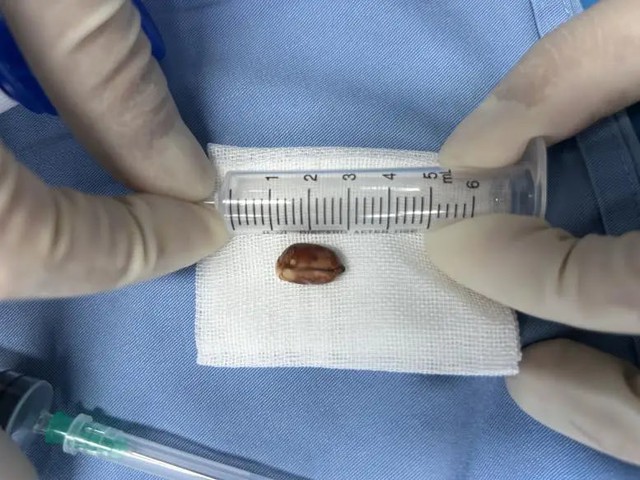 Bé 2 tuổi ăn đậu phộng suýt mất mạng, tim ngừng đập khi đến viện - Ảnh 2.