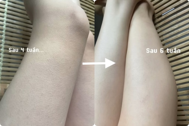 Hơn chục năm bị dày sừng nang lông, cô nàng U30 chỉ cách  - Ảnh 9.