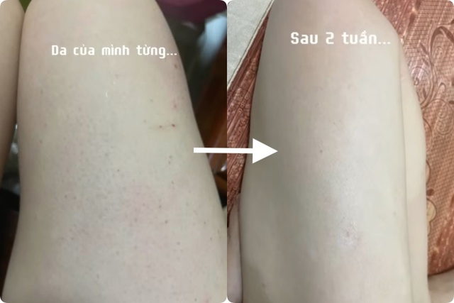 Hơn chục năm bị dày sừng nang lông, cô nàng U30 chỉ cách  - Ảnh 8.