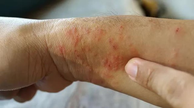 Bộ Y tế cảnh b&aacute;o về bệnh 