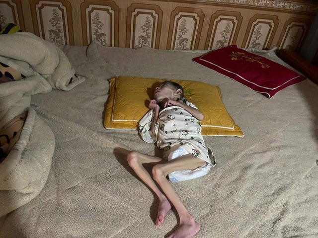 Nỗi đau của người mẹ mang song thai nhưng chỉ c&oacute; một đứa con ch&agrave;o đời mang bệnh bại n&atilde;o - Ảnh 2.