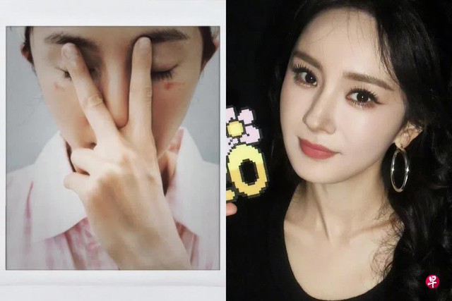 Dương Mịch nghi bị bỏng do mặt nạ mắt hơi nước: Chuyên gia khuyến cáo một điều khi dùng - Ảnh 1.