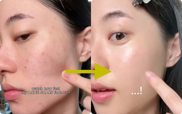 Da mặt th&acirc;m mụn, v&ugrave;ng n&aacute;ch sạm đen hay khuỷu tay th&ocirc; r&aacute;p: Phụ nữ H&agrave;n giải quyết tất cả bằng một tu&yacute;p Vitamin C - Ảnh 9.