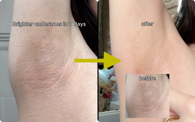Da mặt th&acirc;m mụn, v&ugrave;ng n&aacute;ch sạm đen hay khuỷu tay th&ocirc; r&aacute;p: Phụ nữ H&agrave;n giải quyết tất cả bằng một tu&yacute;p Vitamin C - Ảnh 14.