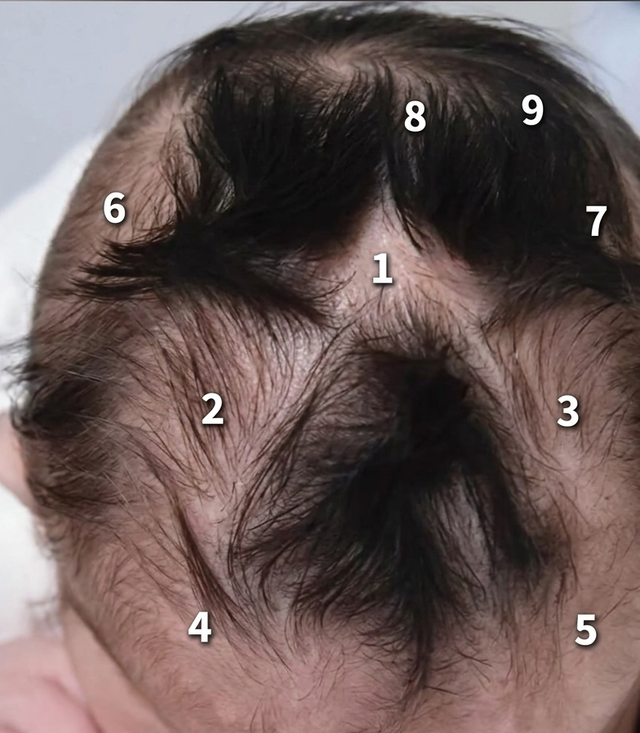 Em bé gây chú ý vì có tới 9 xoáy tóc trên đầu: Liệu có điều gì đặc biệt liên quan đến não bộ của bé? - Ảnh 1.