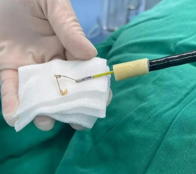 Bé gái 7 tháng tuổi liên tục ho sốt, bác sĩ phát hiện chiếc ghim băng mở bung mắc trong thực quản - Ảnh 2.