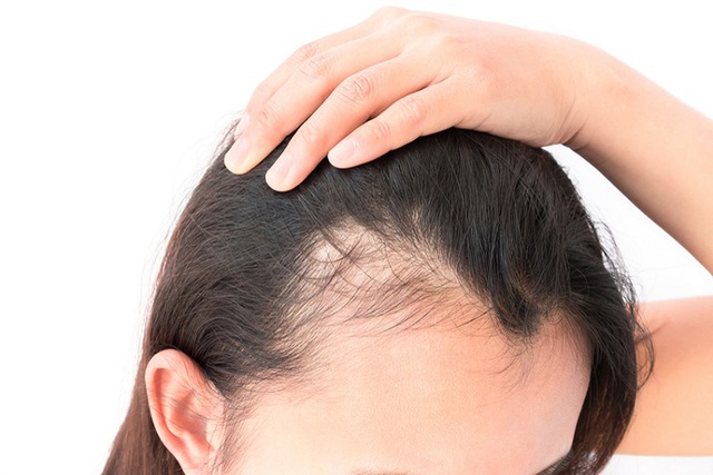 Gội đầu kiểu n&agrave;y cực hại da đầu lại dễ g&acirc;y h&oacute;i: Đ&aacute;ng tiếc nhiều người Việt vẫn mắc, thay đổi ngay h&ocirc;m nay để cứu lấy m&aacute;i t&oacute;c - Ảnh 2.