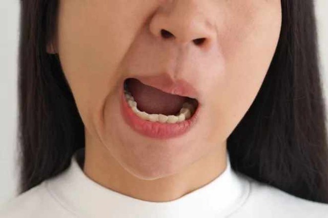 Cảnh b&aacute;o bệnh liệt mặt 