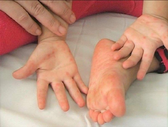 BS khoa Nhi chỉ ra dấu hiệu virus bắt đầu t&aacute;c động v&agrave;o tế b&agrave;o thần kinh, cha mẹ tuyệt đối kh&ocirc;ng được bỏ qua - Ảnh 3.