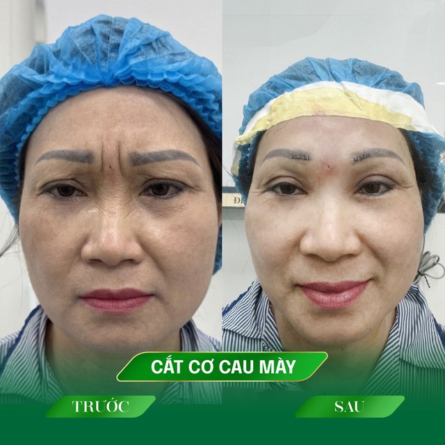 Ths.Bs Phạm Tiến Mạnh với kỹ thuật Utral plus giải pháp cắt triệt cơ cau mày - Ảnh 1.