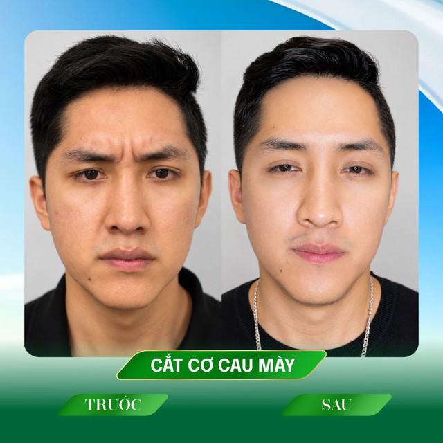 Ths.Bs Phạm Tiến Mạnh với kỹ thuật Utral plus giải pháp cắt triệt cơ cau mày - Ảnh 3.