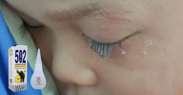 Chỉ 1 phút lơ là mà con gái suýt mù mắt, mẹ bỉm chia sẻ bài học “xương máu” và cách sơ cứu giải nguy trong gang tấc - Ảnh 1.