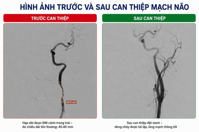 Đang khỏe mạnh, người đàn ông 33 tuổi bất ngờ đột quỵ sau khi chơi bóng đá: Thủ phạm là cú va chạm nhiều người vẫn nghĩ