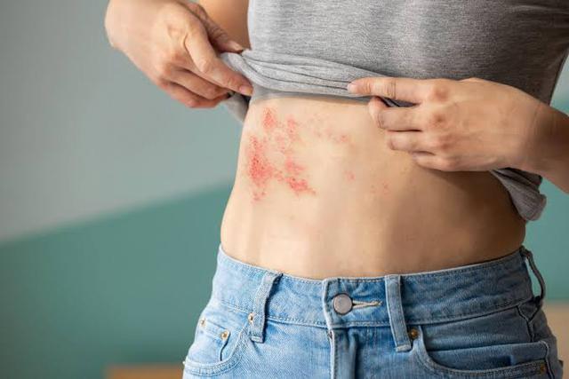Đau đến mất ngủ nhiều đ&ecirc;m, bệnh zona thần kinh kh&ocirc;ng c&ograve;n l&agrave; 