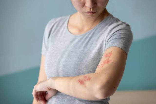 Đau đến mất ngủ nhiều đ&ecirc;m, bệnh zona thần kinh kh&ocirc;ng c&ograve;n l&agrave; 