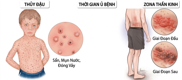 Đau đến mất ngủ nhiều đ&ecirc;m, bệnh zona thần kinh kh&ocirc;ng c&ograve;n l&agrave; 