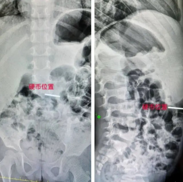 Con nuốt phải tiền xu, mẹ tuyệt đối đừng móc họng! Hãy thuộc lòng ngay quy trình "giải cứu" sau đây - Ảnh 1.