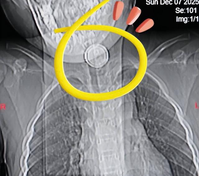 Bé trai 4 tuổi nuốt phải pin cúc áo, bà nội đòi chữa theo mẹo dân gian nhưng bác sĩ cảnh báo tuyệt đối không làm theo - Ảnh 2.