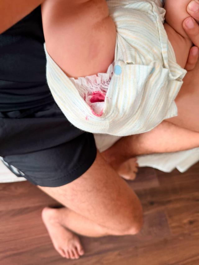 Mẹ bỉm một phen hồn vía lên mây khi thấy màu đỏ thẫm khi mở tã của con trai, nhìn kỹ mới nhận ra