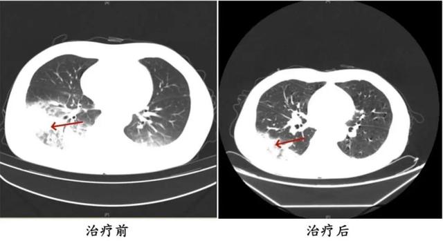 Bật điều h&ograve;a ngủ một đ&ecirc;m, người phụ nữ sốt cao li&ecirc;n tục, phổi tổn thương hơn một nửa: B&aacute;c sĩ cảnh b&aacute;o mối nguy &iacute;t ai ngờ ngay trong nh&agrave; - Ảnh 2.