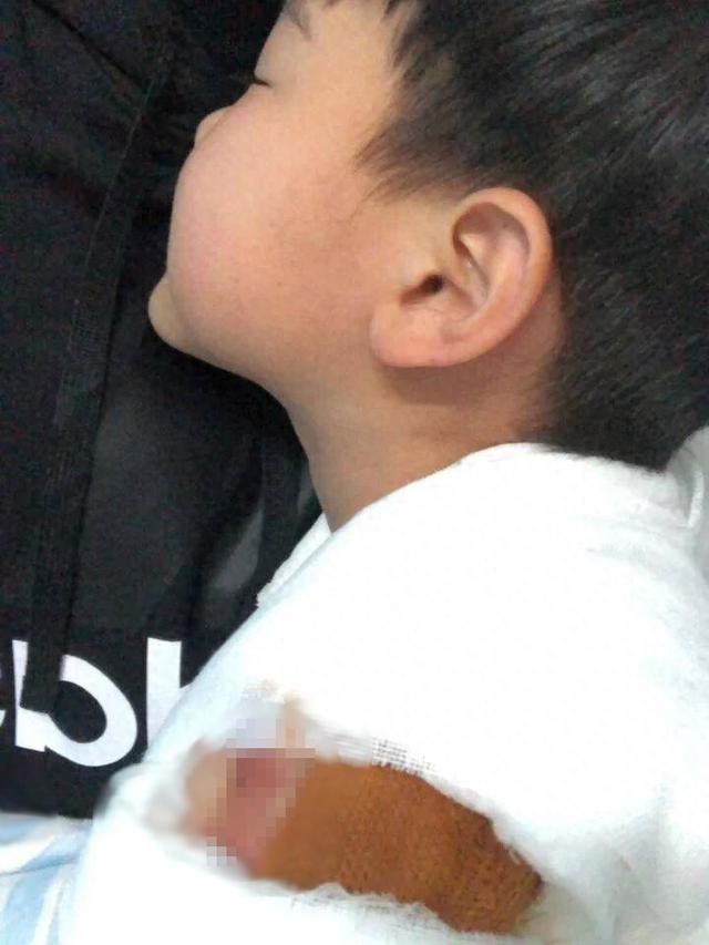 B&eacute; g&aacute;i 1 tuổi bị ch&aacute;o n&oacute;ng đổ v&agrave;o người, c&aacute;ch sơ cứu sai của b&agrave; khiến vết bỏng nghi&ecirc;m trọng hơn - Ảnh 1.