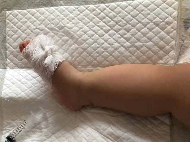 B&eacute; g&aacute;i 1 tuổi bị ch&aacute;o n&oacute;ng đổ v&agrave;o người, c&aacute;ch sơ cứu sai của b&agrave; khiến vết bỏng nghi&ecirc;m trọng hơn - Ảnh 2.