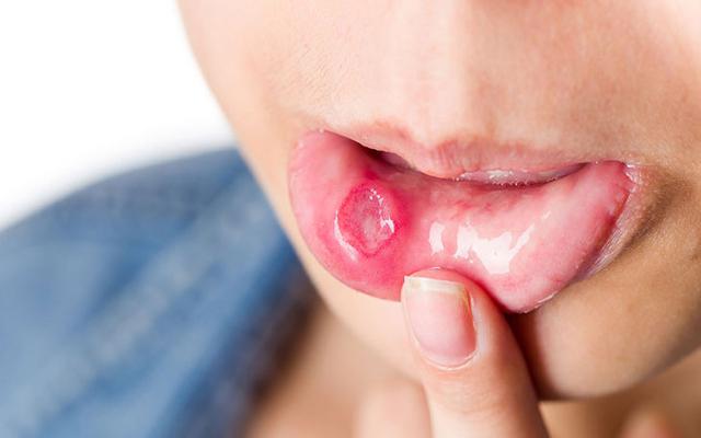 Miệng hay bị nhiệt, kh&ocirc; v&agrave;o m&ugrave;a thu, ăn g&igrave; để &ldquo;giải cứu&rdquo;? Những thực phẩm quen thuộc c&oacute; thể khiến bạn bất ngờ - Ảnh 1.