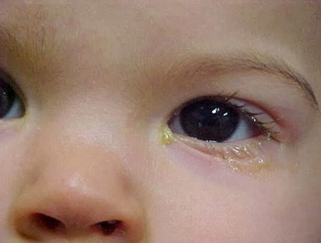 "Nhỏ sữa mẹ vào mắt con để chữa bệnh": Đã bao trường hợp trẻ phải khoét bỏ mắt nhưng vẫn có mẹ áp dụng hàng ngày - Ảnh 1.