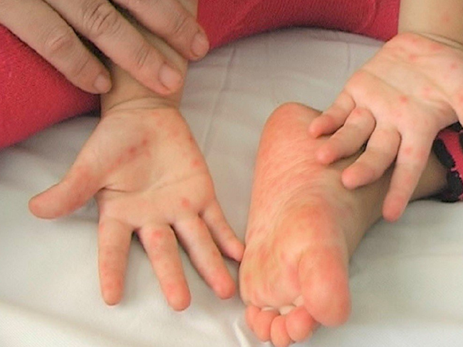 1 trường mầm non khiến phụ huynh bức xúc vì giấu kín chuyện học sinh bị bệnh truyền nhiễm, hàng loạt em bị lây sau đó - Ảnh 2. 1 trường mầm non khiến phụ huynh bức xúc vì giấu kín chuyện học sinh bị bệnh truyền nhiễm, hàng loạt em bị lây sau đó - Ảnh 2.