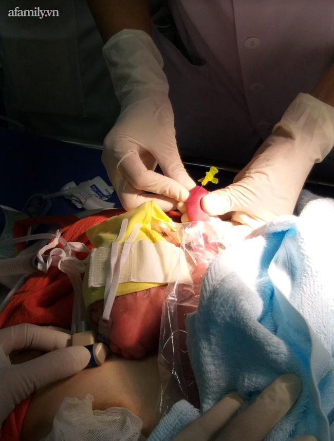 Bé gái Long An sinh "cực non" chỉ nặng 700gram, được bác sĩ cứu sống ngoạn mục